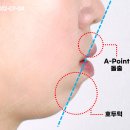 태기출치과의원 | 무턱 교정 수술 없이는 불가능한가요? (여자분 치아교정 후기)