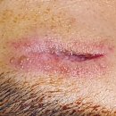 나노성형외과의원 | 상처성형외과 찐 추천! 상처 전문 치료 병원은 다르네요.