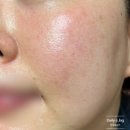 마이피부과의원 | [홍조레이저후기/홍조레이저추천/GV레이저] 블리스의원