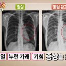 ﻿폐 노인성 폐렴 의심 증상 이미지