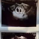 연이산부인과의원 | [임신 극 초기~8주 차] 쌍둥이,임신확인,임밍아웃,태몽,먹덧,극초기증상 👶✌️💛