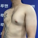 트루맨 | 여유증 수술 후기 ✨ 트루맨 강남점 복강경 리얼 경험담