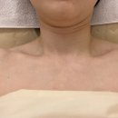 망포역 피부관리 더엘에스테틱 V핏 비리본리프팅 후기 팔자주름 이중턱 관리