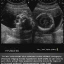 Hypotelorism, proboscis, with Holoprosencephaly and overriding of aorta in fetus 이미지