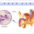 비임균성 요도염 이미지