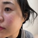 범어동 피부과 속건조 개선, 수성구 한의원 모공리액터 3회 후기