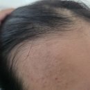 이마라인? 헤어라인 봐주세요 이미지