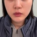 이브 | 잠실새내역 피부과 광대볼륨 중안부 개선 이브타이탄 후기