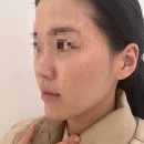 압구정-269 | 물방울리프팅 가격 효과 압구정 꽁쌤에스테틱