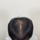 닥터베이직의원 | 정수리 탈모 SMP 두피문신 후기 (feat. 가르마, 확산성 탈모 치료)