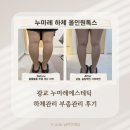 톡스마토탈샵 | 광교 하체관리 추천 누마레에스테틱 올인원톡스로 붓기 라인 정리 후기