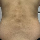 다함한의원 | [임신 소양증 일기 3] 출산 후 5개월 지난 현재 소양증 후기 마지막 글