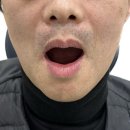 풀아치 임플란트 후기, 치아를 모두 잃은 환자분