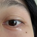 [신림] 희망찬안과의원 - 다래끼 수술 후기 비용 고통