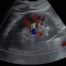 [비뇨기계] Renal stone woth hydronephrosis, right kidney 이미지