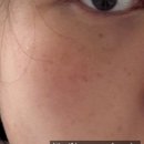 헐리우드 | [내돈내산] 클라리티 레이저 + 헐리우드 토닝 후기(잡티/흑자 제거)