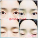 미샤AK수원 | 수원 절개쌍수 당일후기_세미아웃