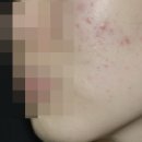 천지한의원 | 대전여드름전문 한의원 반복되는 질환을 잠재우기 위한