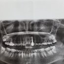 치근파절 상해수술비 이미지