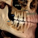 평화치과의원 | [아산 연세원치과]이비인후과 가도 안 낫는 축농증, 원인은 '상악 사랑니'일 수 있습니다