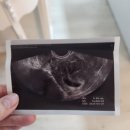 임신초기 7주차 아기 심장멈춤 계류유산 소파술 후기 (출혈/몸조리/운동)