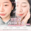 예술회관역 | 인천 구월동 예술회관역 피부과, 티타늄 대신 포트라 콰트로 리프팅 받은 추천 후기