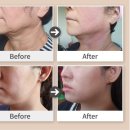 시그널성형외과의원 | 부산 인모드, 받기 전에 이게 제일 궁금하셨죠? 후기만 보면 안되는 이유!