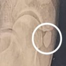 화이팅정형외과의원 네이버블로그