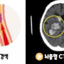 내 몸에 소리없이 불어오는 바람, 중풍(中風) 이미지