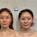 인천 윤곽관리 안면비대칭교정 무통증으로 비포애프터 확실한 루나크 부평본점