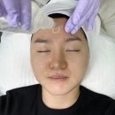 제이스테이 | 스킨플래닝 후기 효과 주기 부작용 스테이제이뷰티