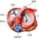 심장 판막질환 후천적 퇴행성 질환 이미지