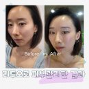 엘라비에 | 신논현피부과 스킨부스터 엘라비에 리투오 후기