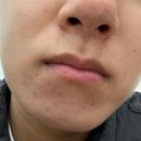 리메이의원 | 용인 피부과 메이퓨어의원 수지점, 카프리레이저 입주변 여드름 원인 치료 2회차 후기