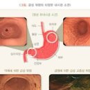 위염 종류 위축성위염 장상피화생 이미지