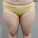 강남역 지방흡입 vs 마운자로/위고비 어떤게 좋을까 [비용, 후기]