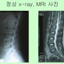 허리디스크 x-ray, mri를 잘 보기 위해서 반드시 필요한 것은? 이미지