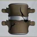 마디마디신경외과의원 | 집에서 하는 견인기 사용 정말 도움이 될까 궁금하다면