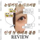 볼륨 | 내돈내산 강남피부과 인생 첫 눈밑 쥬베룩볼륨 후기