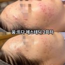 심신 안정을 위한 아로마테라피 | 화농성 트러블 관리 2회차, 마곡 움트다 에스테틱