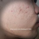 에이제로 | 여드름 연고 대신 클리니 에이제로샷, 3일간 직접 써본 솔직후기