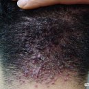 김희옥피부과의원 | 1. 켈로이드성 여드름(Acne keloidalis)[요약][진단][치료] - 켈로이드여드름 - 한국에 흔한 피부질환...