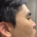 [수원/팔달구] 수원여드름피부과 추천 네오빔 찐후기 3탄 :: 후한의원 수원
