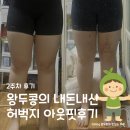 신사약국 | [다이어트] 신사역 8번출구 아웃핏 지방추출주사 허벅지 후기 수술당일부터 2주차 후기 및 통증, 바본관리