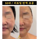포천 50대 피부 탄력 고주파관리 / 어썸웰스파