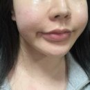 🏥피부과 가기 애매할 때 찾게 되는 여드름 피부 화장품! AC B6 데일리 솔루션 솔직 사용 후기