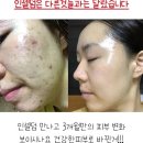 미현 인셀덤