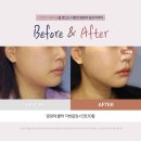 메이크유성형외과의원 | 얼굴지방흡입후기 실리프팅 같이 해야 좋은 이유