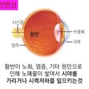 미소아이안과 네이버블로그