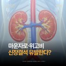 2020-962 | 마운자로·위고비 신장결석 유발한다? 팩트체크